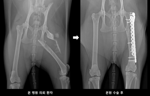 대퇴골 골절 수복 전 및 수복 후 사진