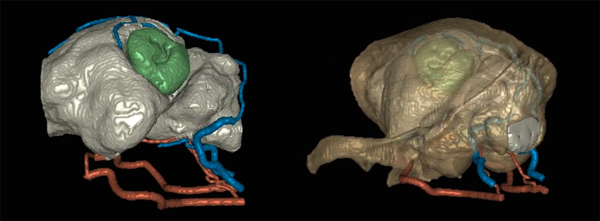 MRI 혈관 조영술을 통해한 혈관 및 종양의 3D 재건